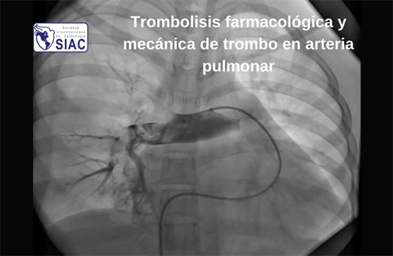 Caso clínico 'Trombolisis farmacológica y mecánica de trombo en arteria pulmonar', gratuito