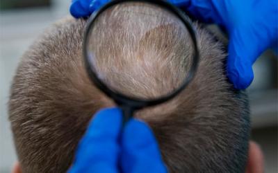Te contamos sobre esta técnica no invasiva para afrontar la alopecia. 