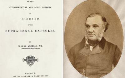 Thomas Addison y la enfermedad de bronce, que lleva su nombre - Cátedra - El Diario de Salud 