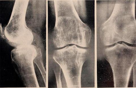Estudio Indica Que Las C lulas Causantes De La Osteoporosis Podr an Ser Estudio Indica Que Las C lulas Causantes De La Osteoporosis Podr an Ser